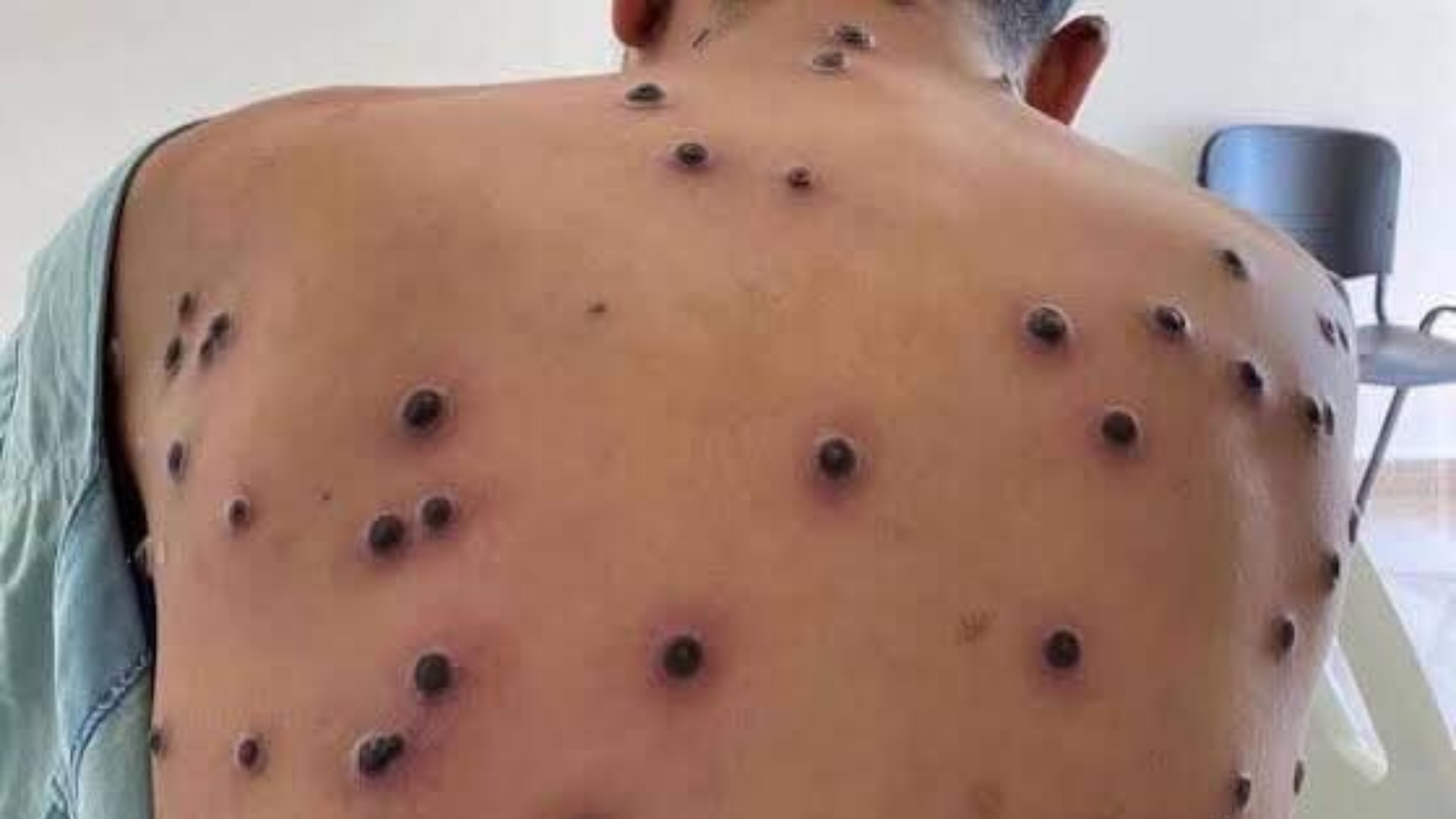 Portel em alerta contra a Mpox: município reforça orientações para prevenir a chegada da doença